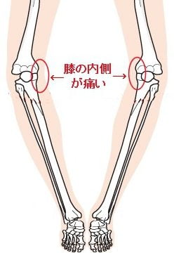 O脚は膝の内側に負担が多くかかり 関節軟骨がすり減り 骨同士がこすれ合う状態になって痛みが現れます。